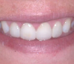 Veneers